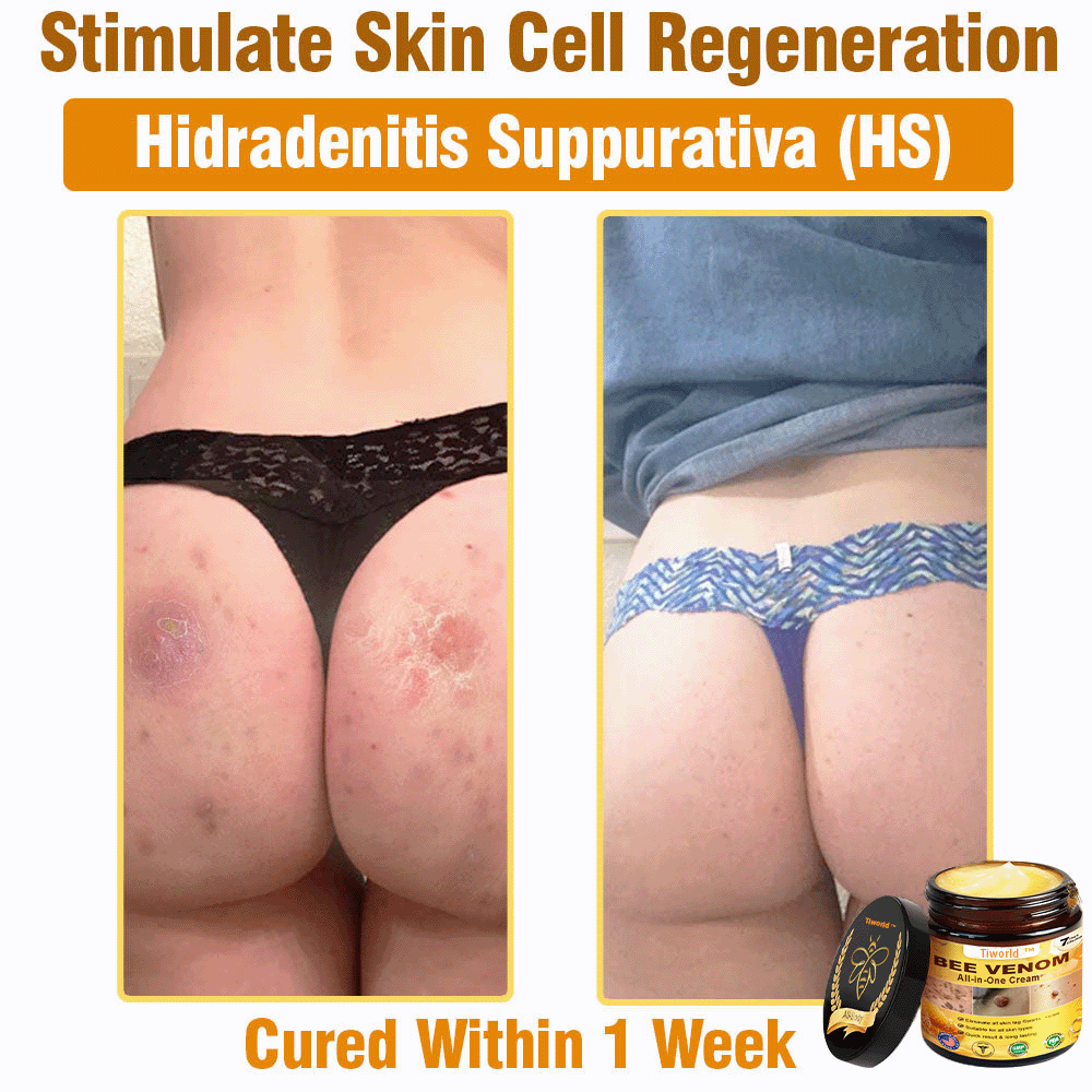 Tiworld™ Bee Venom All-in-One Cream 👩‍⚕️US Dermatologist Approved
