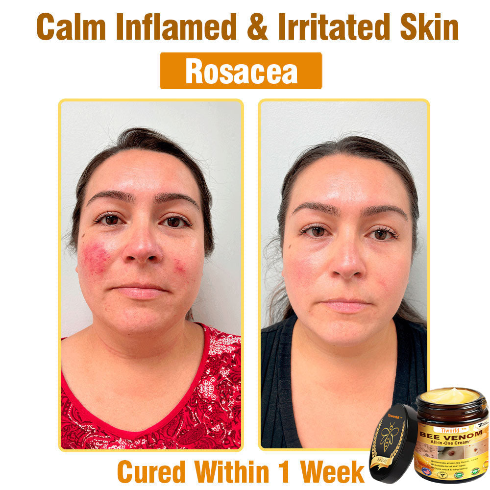 Tiworld™ Bee Venom All-in-One Cream 👩‍⚕️US Dermatologist Approved