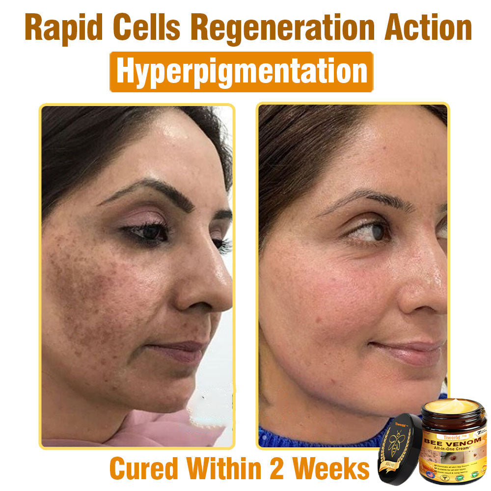 Tiworld™ Bee Venom All-in-One Cream 👩‍⚕️US Dermatologist Approved